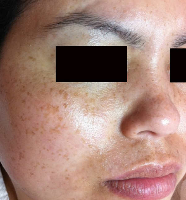 Before-facefour